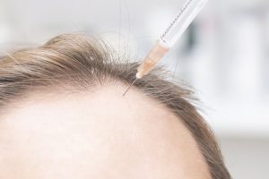 سئوالات متداول در مورد کاشت مو به روش pbs