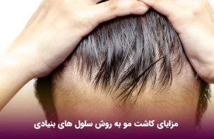 مزایای کاشت مو به روش سلول های بنیادی