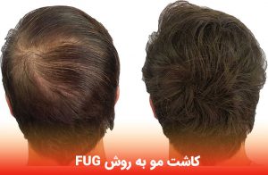 کاشت مو به روش FUG