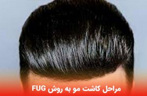 مراحل کاشت مو به روش FUG