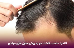 کاندید مناسب کاشت مو به روش سلول های بنیادی