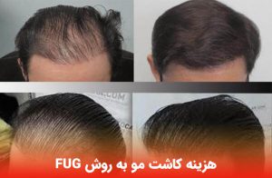 هزینه کاشت مو به روش FUG