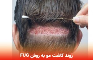 روند کاشت مو به روش FUG