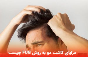 مزایای کاشت مو به روش FUG چیست