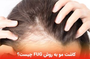 کاشت مو به روش FUG چیست