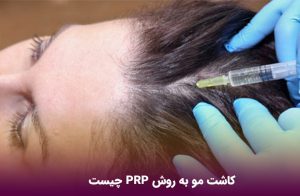 کاشت مو به روش PRP چیست