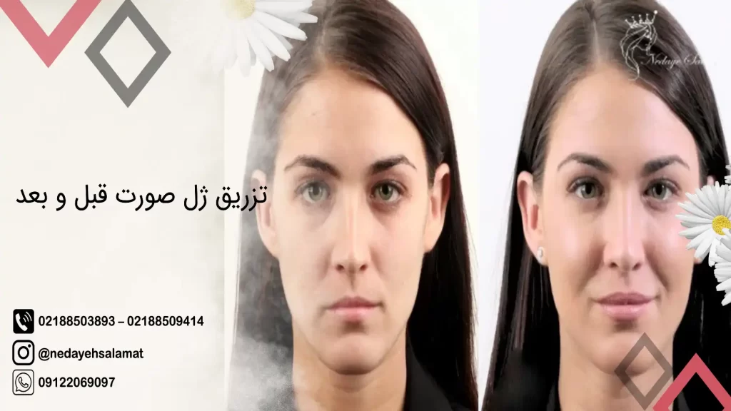 تزریق ژل صورت قبل و بعد