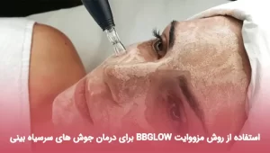 استفاده از روش مزووایت BBGLOW برای درمان جوش های سرسیاه بینی