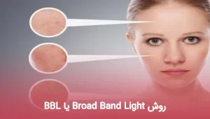 روش Broad Band Light یا BBL