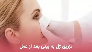 تزریق ژل به بینی بعد از عمل